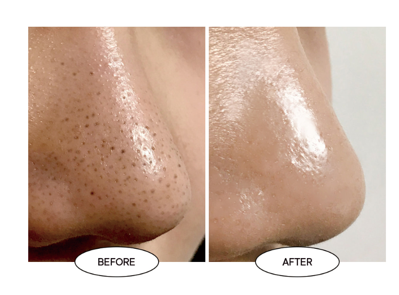 Средство от черных точек One-Day's You P.Z Ssoc Ssoc No More Blackhead 100 мл